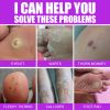 South Moon Chicken Eye Lotion Extra Clear s Skin Care Chicken es Foot Pad Gram Warts